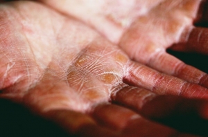 Eczema care and treatment tips Eczema care and treatment tips